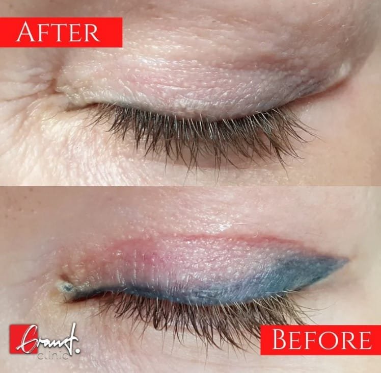 Eyeliner Tattoo Removal The Pain and Struggles